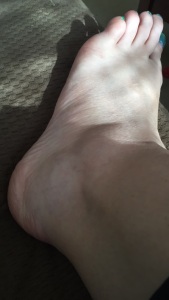 This is not how my ankle normally looks. 